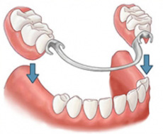 dentiste-prothese
